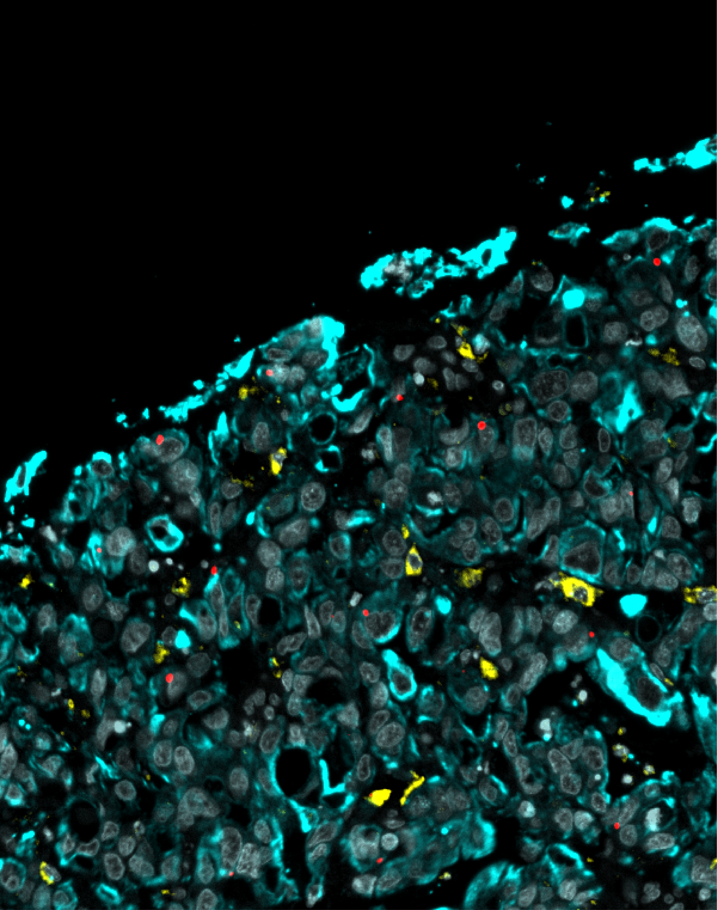 Oesophagal adenocarcinoma section visualised by multiplexed immunofluorescence, showing cell nuclei (greyscale) and micronuclei (aberrant nuclear structures formed when chromosomes are improperly segregated during cell division; red) interspersed throughout the malignant cell compartment (cyan). Infiltrating macrophages are shown in yellow.