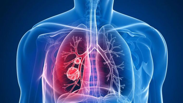 Illustration in blue colors of a transparent human body with lungs with cancer cells in red