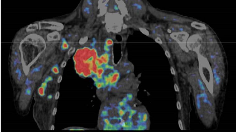 18F-Misonidazole PET-CT scan showing a large left upper lobe tumour with lymph node metastases. Hypoxic areas of the tumour are represented by red regions on the scan.